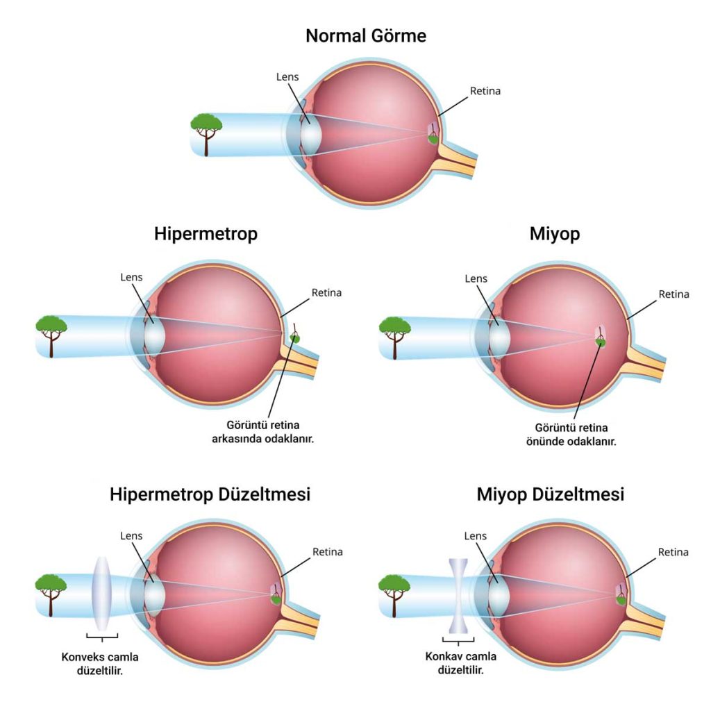 Miyop Tedavisi-Hipermetrop Tedavisi