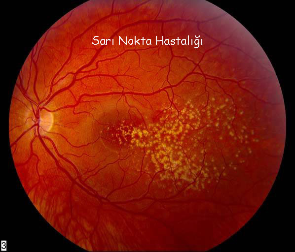 Sarı Nokta Hastalığı