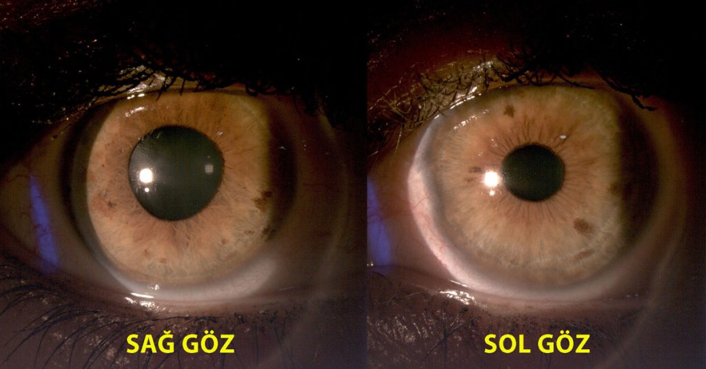 Göz Bebeği Büyümesi