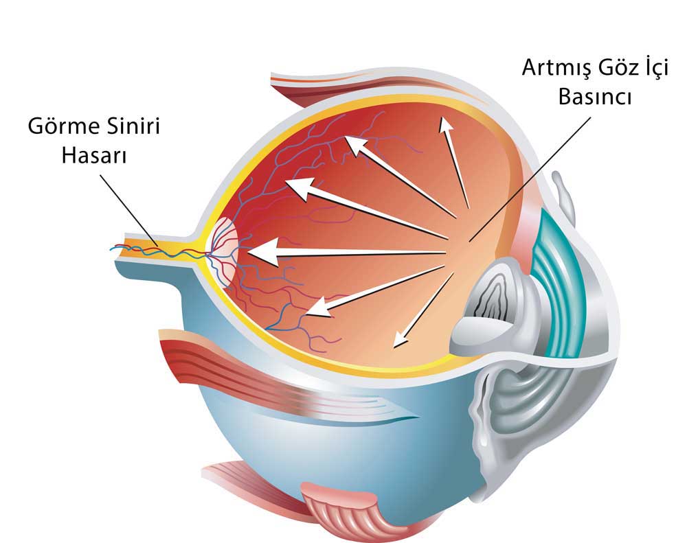 Göz Tansiyonu — Glokom