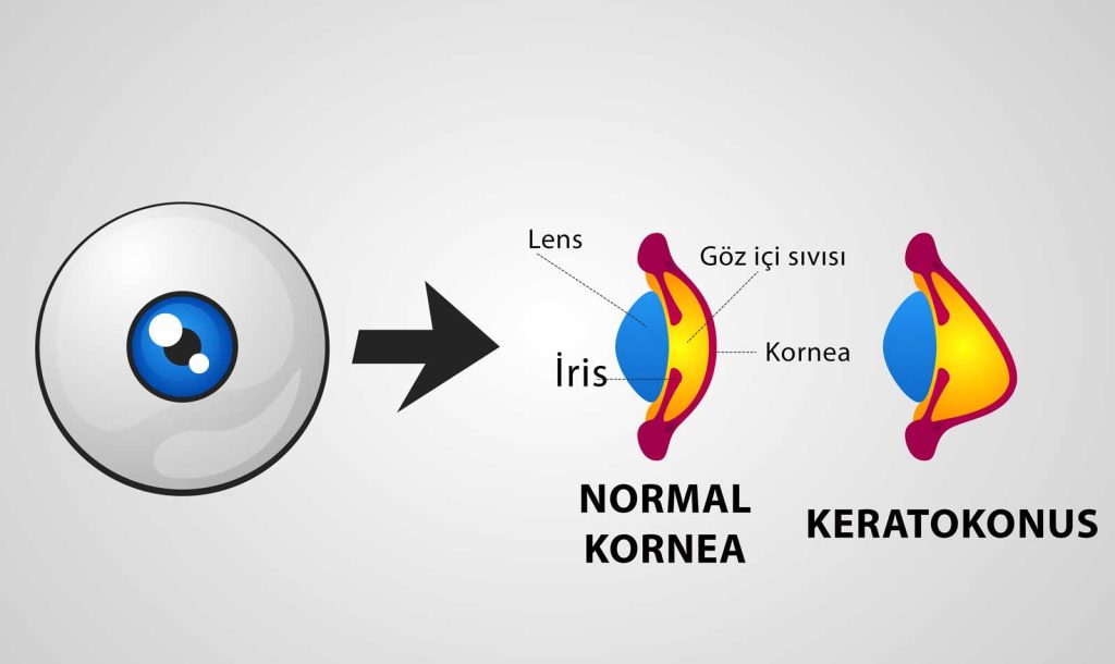 Keratokonus-Kornea Dikleşmesi-Kornea İncelmesi