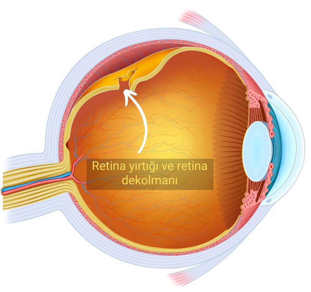 Retina Yırtılması