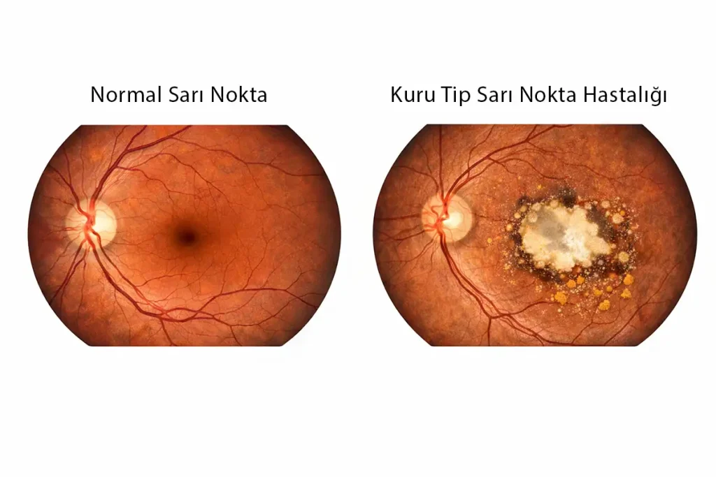 Normal makula ile kuru tip sarı nokta hastalığında coğrafik atrofi bulunan makulanın karşılaştırmalı retina görüntüsü