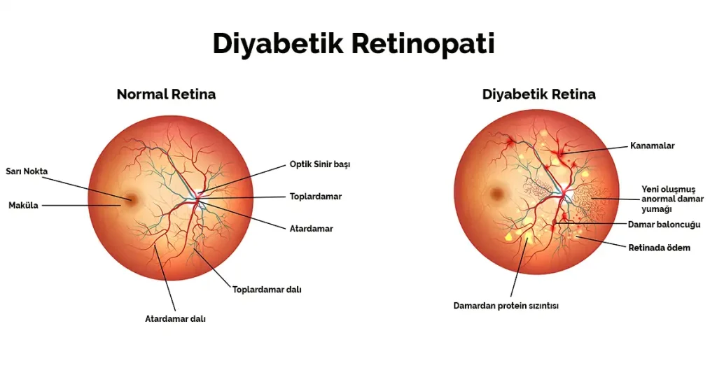 Normal retina damarları ile diyabetik retinopatide görülen damar değişikliklerini karşılaştıran şematik diyagram