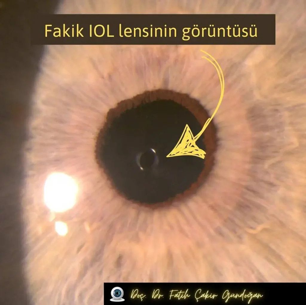 Fakik IOL göz içi lensinin göz içerisindeki görünümü