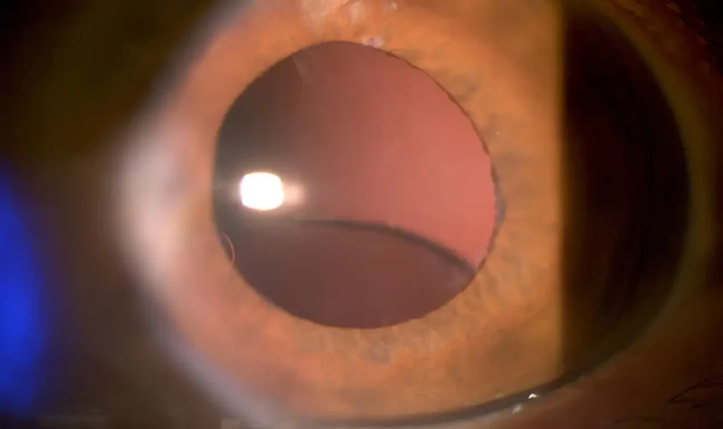 Katarakt ameliyatı sonrası yapay göz içi merceğin aşağı doğru kaydığı göz görseli